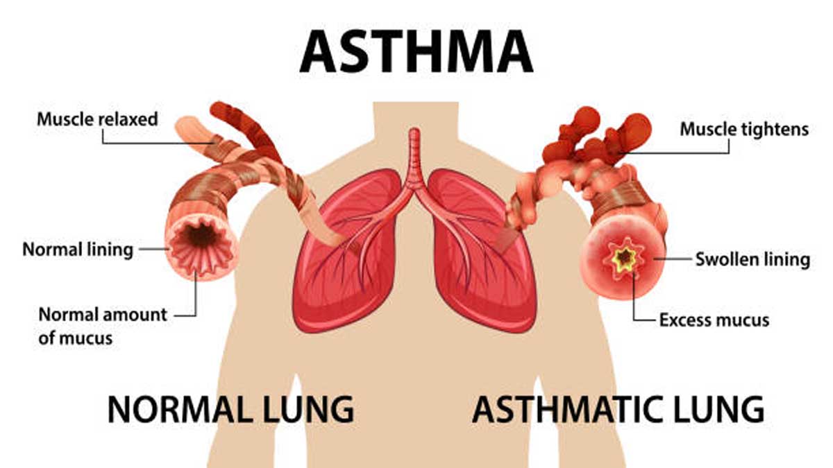Asthma: Symptoms, Causes, Treatment