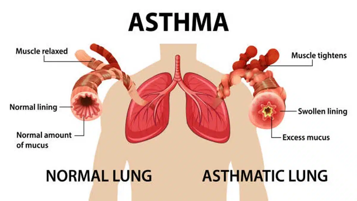 Asthma: Symptoms, Causes, Treatment