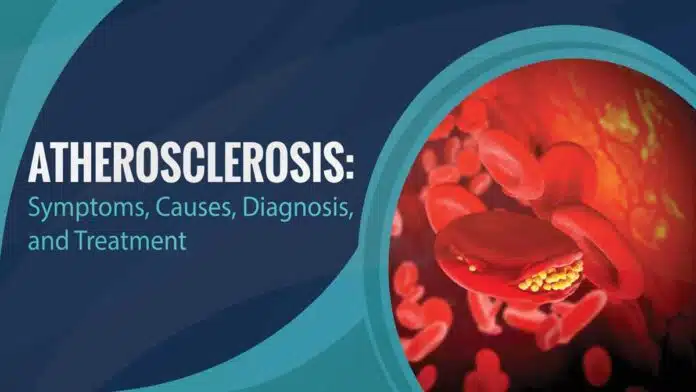 Atherosclerosis: Causes, Symptoms, Diagnosis