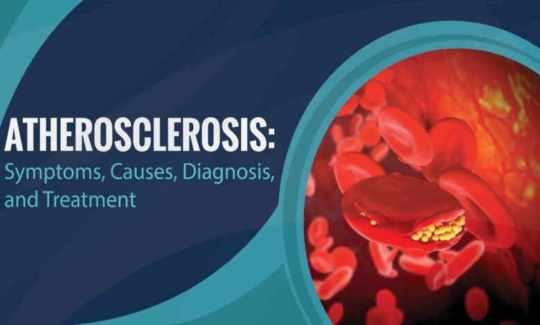 Atherosclerosis: Causes, Symptoms, Diagnosis