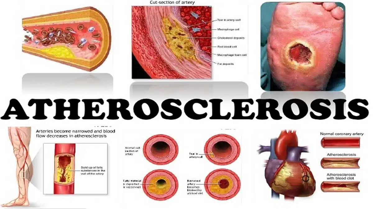 Atherosclerosis: Causes, Symptoms, Diagnosis