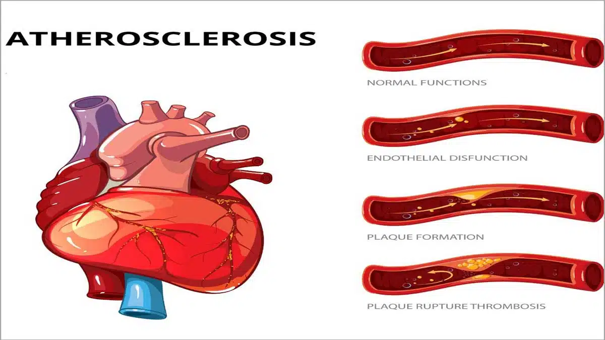 Atherosclerosis: Causes, Symptoms, Diagnosis