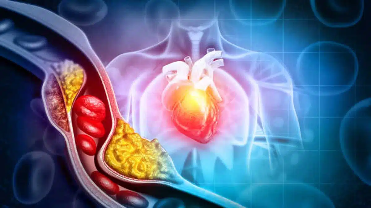 Atherosclerosis: Causes, Symptoms, Diagnosis
