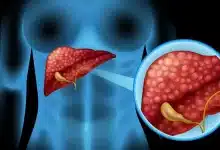 Beginning of Liver failure Know the 8 dangerous symptoms!
