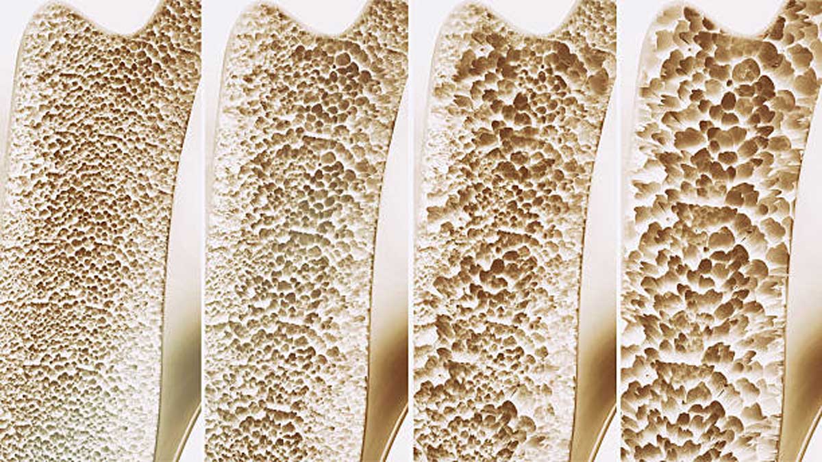 Bone Disorders: Causes, Symptoms, Types