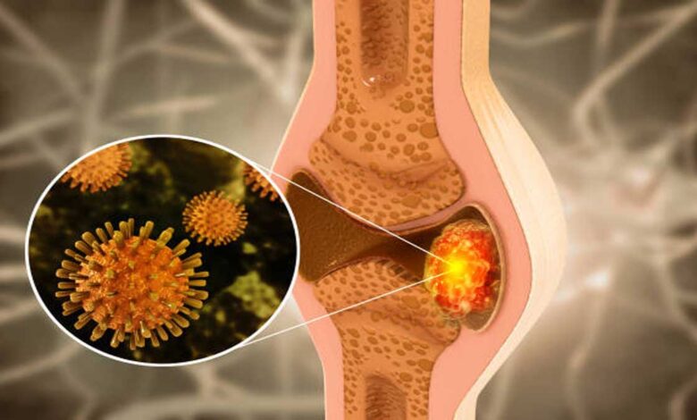 Bone Disorders: Causes, Symptoms, Types