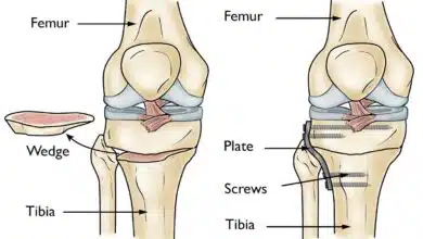 Bone Problems and Diseases: Causes