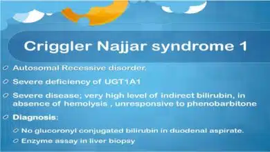 Crigler-Najjar Syndrome: Causes, Symptoms