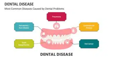 Dental Diseases: Causes, Symptoms, Treatment