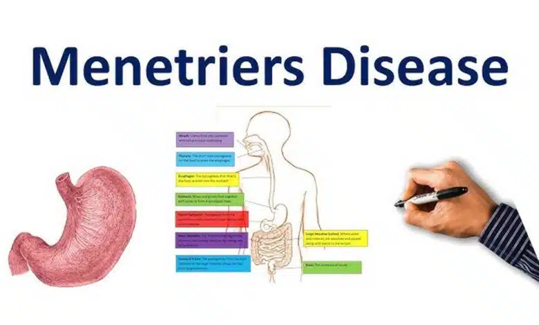 Ménétrier's Disease: A Comprehensive Guide