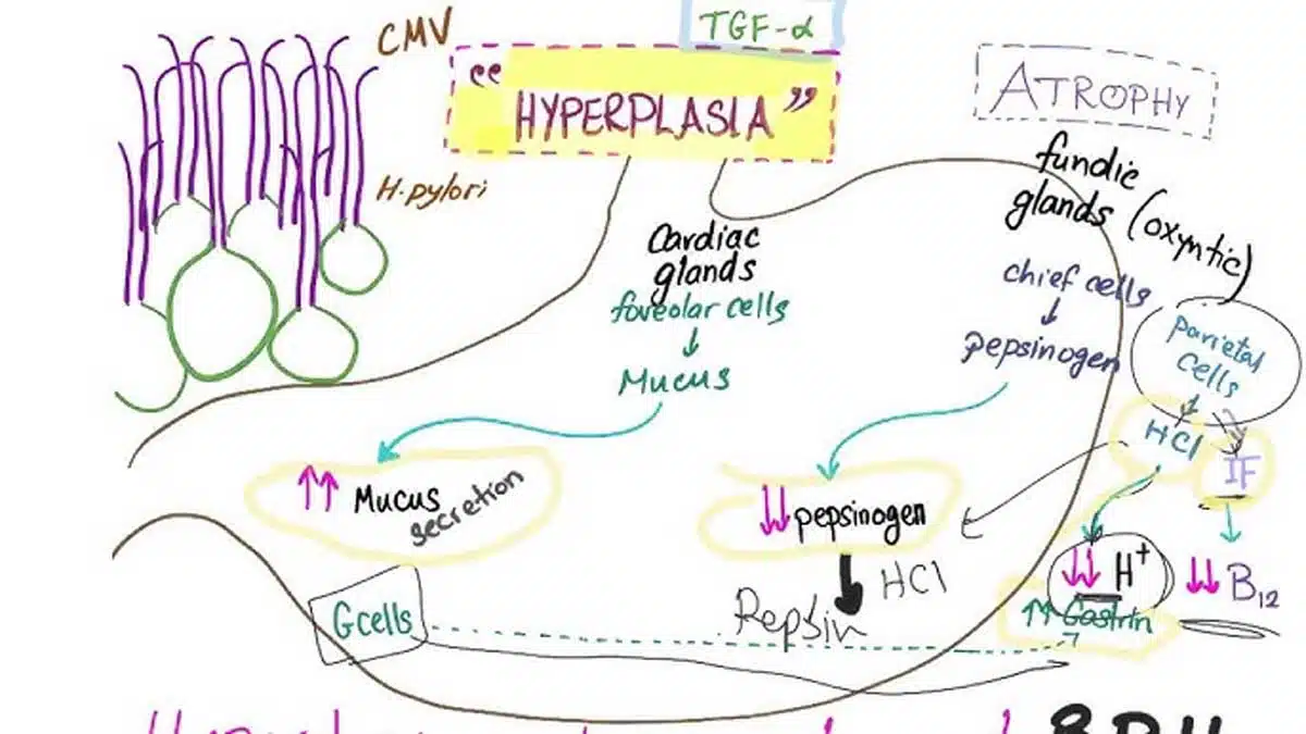 Ménétrier's Disease: A Comprehensive Guide