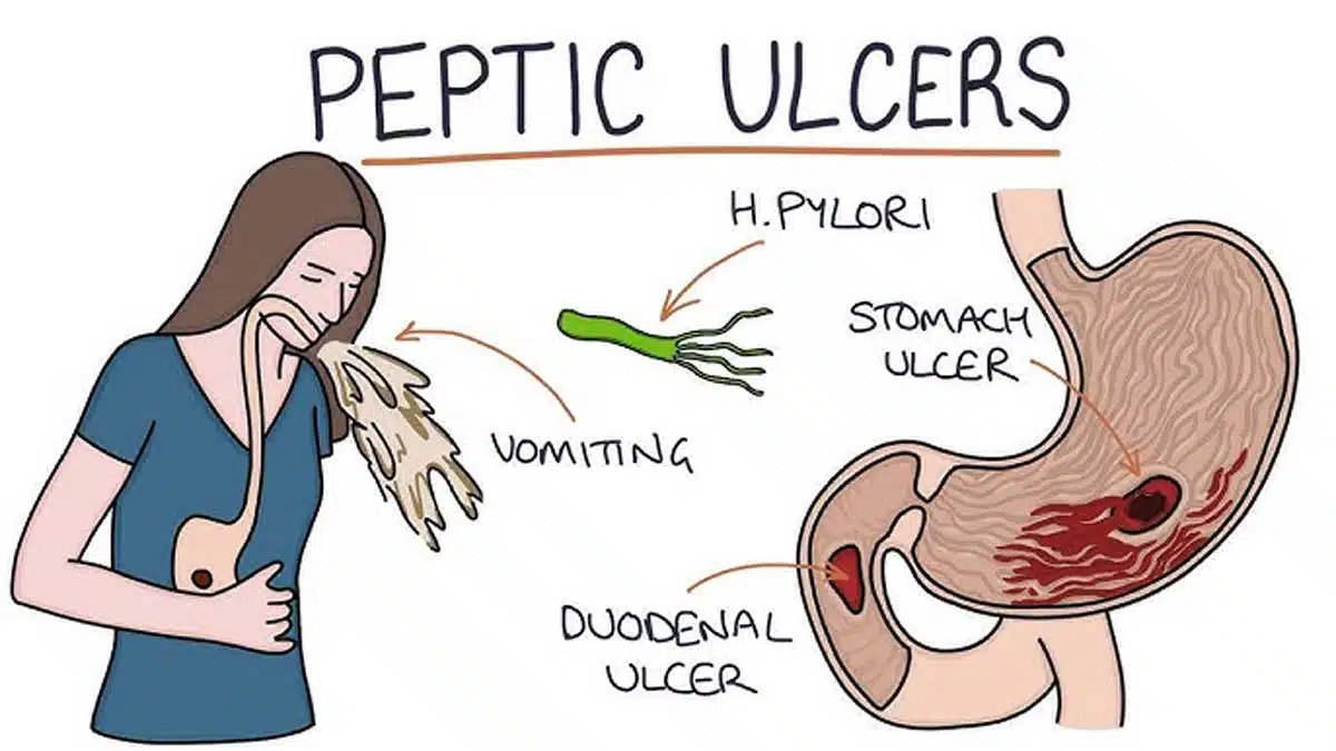Ménétrier's Disease: A Comprehensive Guide