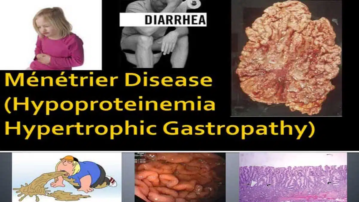 Ménétrier's Disease: A Comprehensive Guide