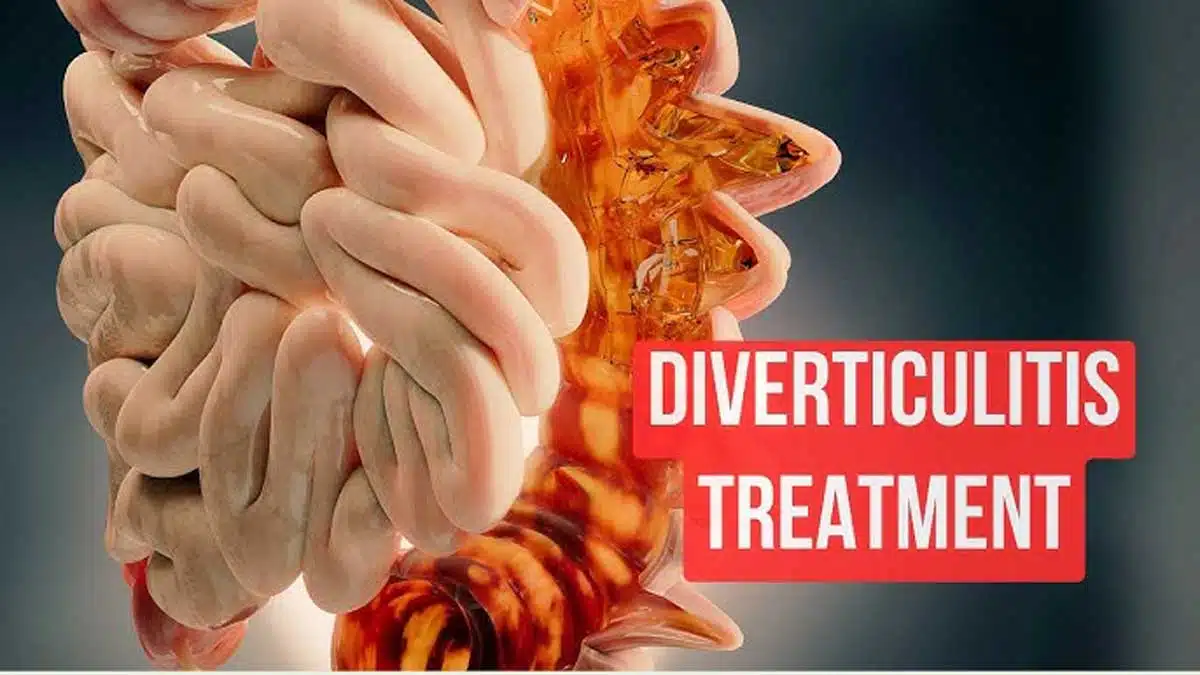 Diverticulitis: Symptoms, Causes, Diagnosis