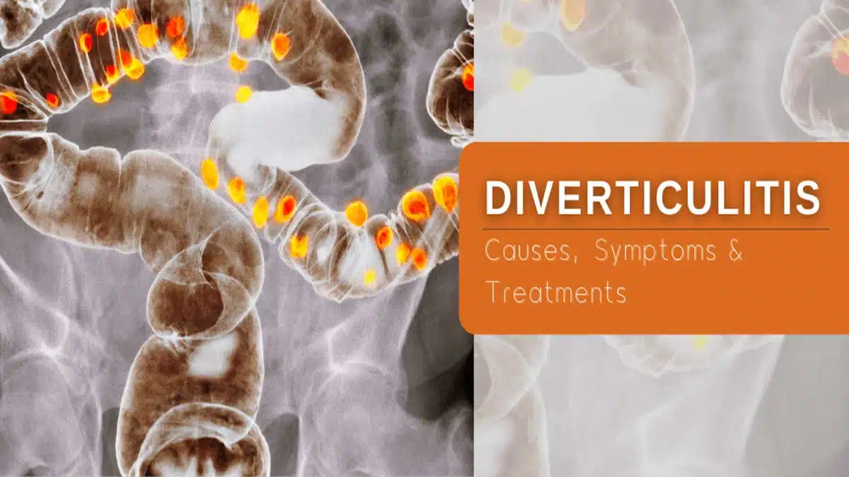 Diverticulitis: Symptoms, Causes, Diagnosis
