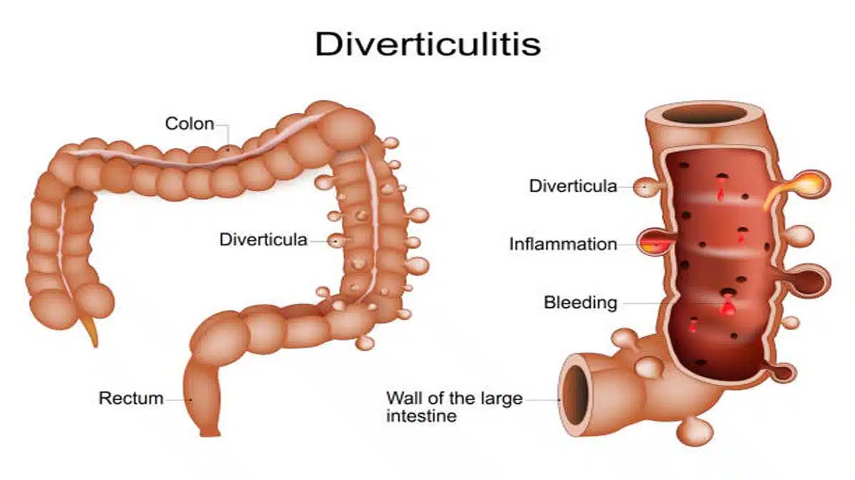 Diverticulitis: Symptoms, Causes, Diagnosis