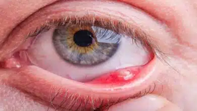 Eye Diseases: Causes, Symptoms, Treatment