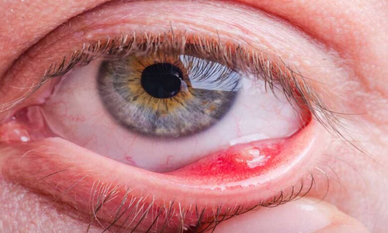 Eye Diseases: Causes, Symptoms, Treatment