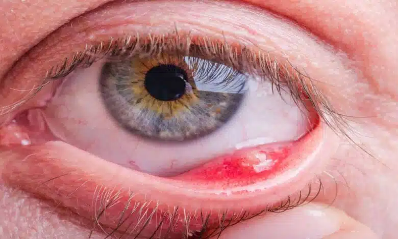 Eye Diseases: Causes, Symptoms, Treatment