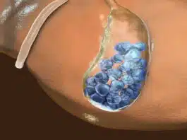 Gallstones: Causes, Symptoms, Treatment