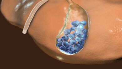 Gallstones: Causes, Symptoms, Treatment