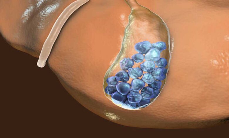Gallstones: Causes, Symptoms, Treatment