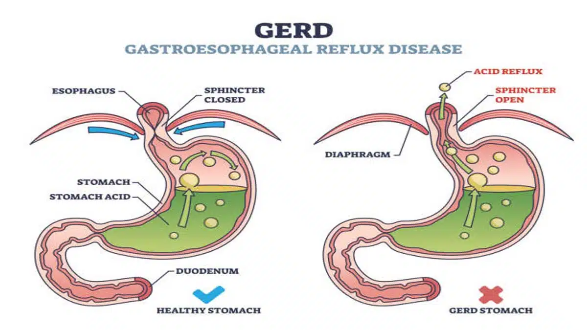 Gastroesophageal Reflux Disease (GERD): Causes, Symptoms