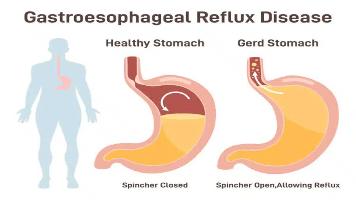 Gastroesophageal Reflux Disease (GERD): Causes, Symptoms