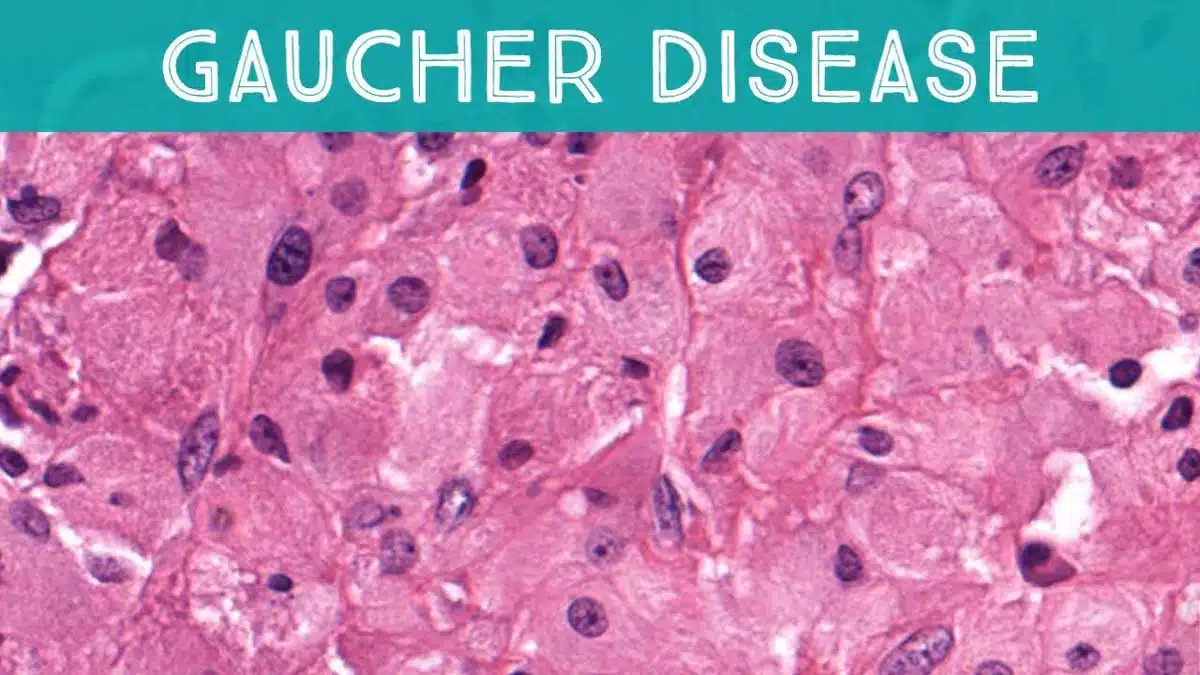 Gaucher Disease: Complete Information, Causes