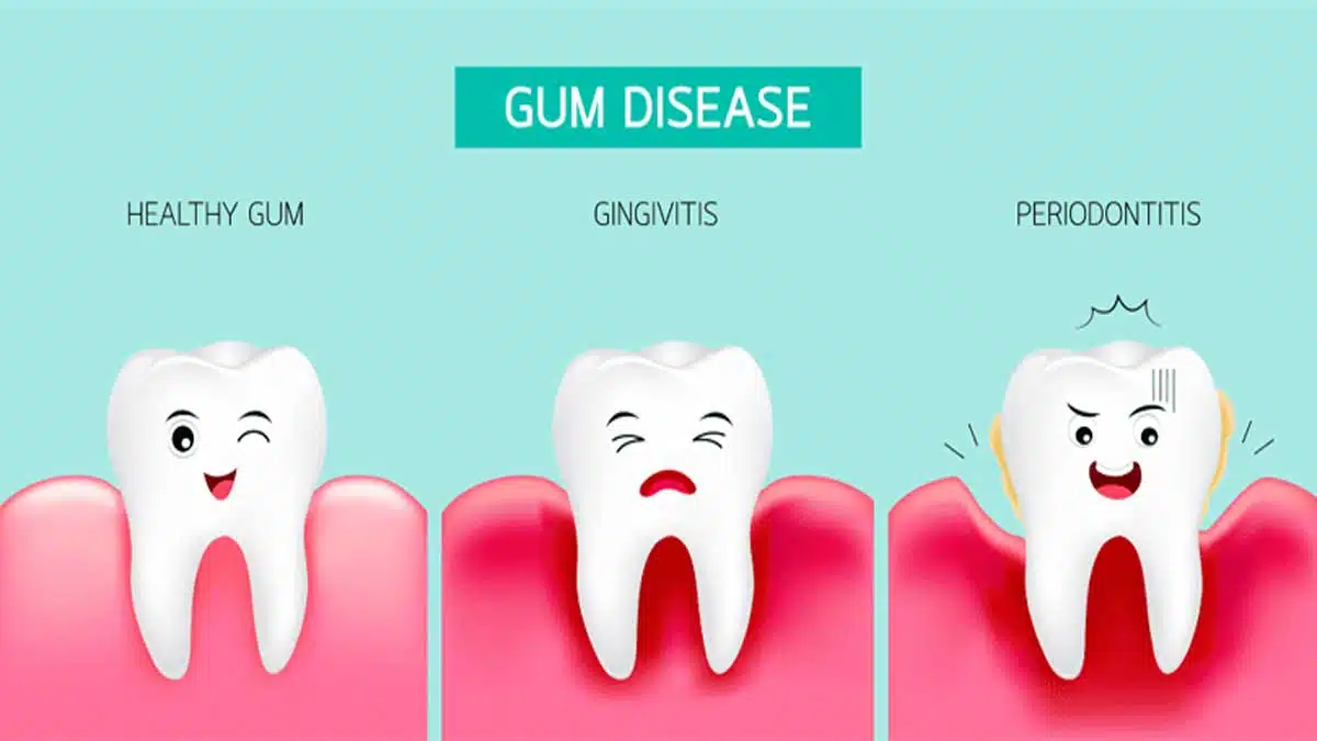 Gum Problems and Diseases: Causes