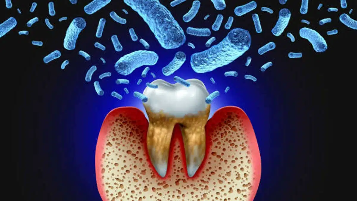 Gum Problems and Diseases: Causes