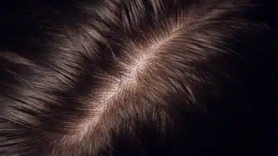 Hair Problems: Causes, Symptoms, Treatment