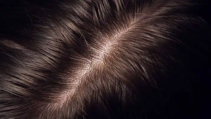 Hair Problems: Causes, Symptoms, Treatment