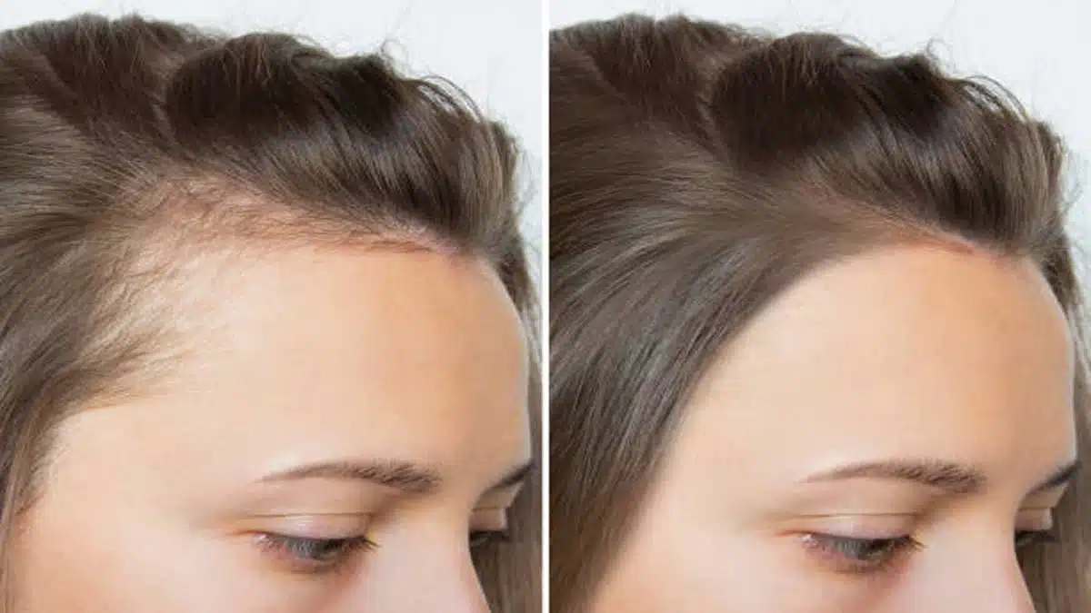 Hair Problems: Causes, Symptoms, Treatment