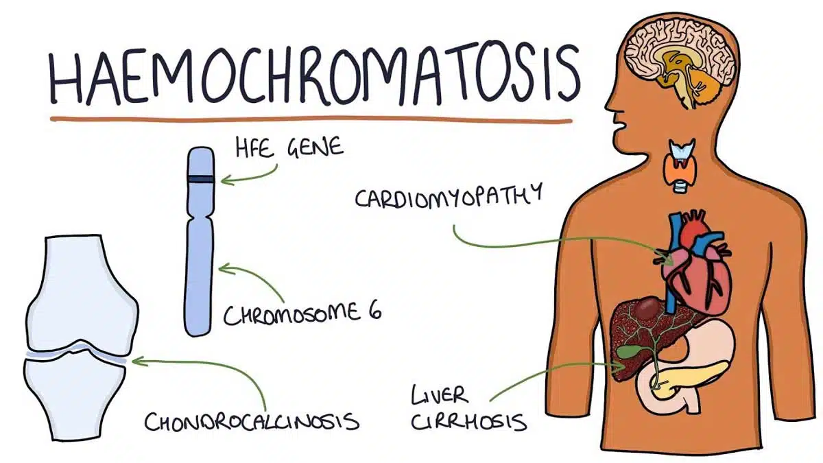 Hemochromatosis: Causes, Symptoms, Diagnosis