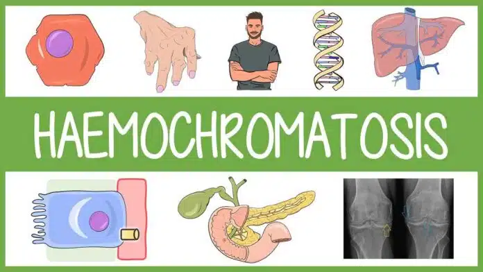 Hemochromatosis: Causes, Symptoms, Diagnosis