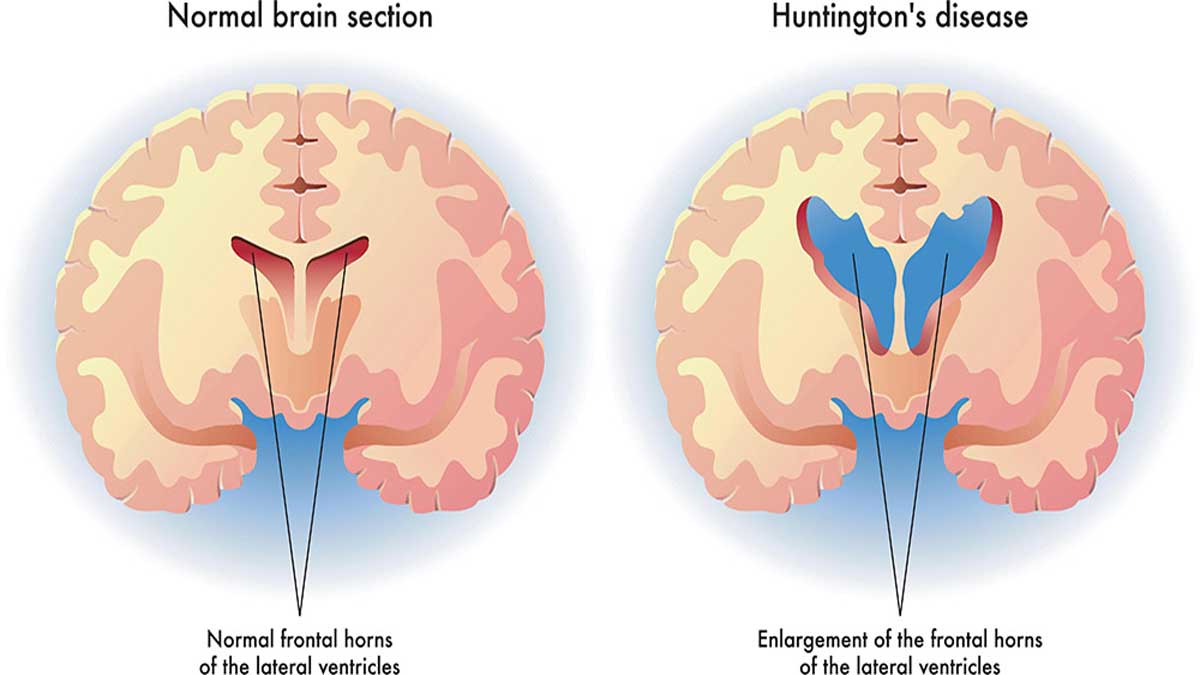 Huntington's Disease: A Genetic and Neurological