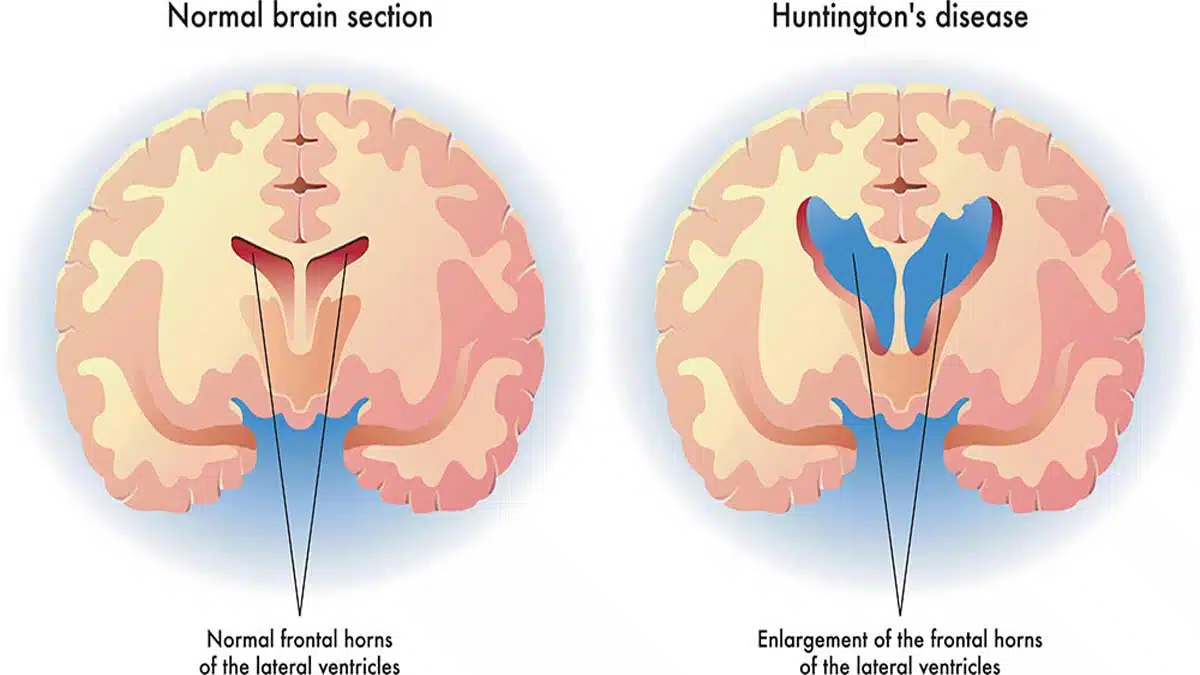 Huntington's Disease: A Genetic and Neurological