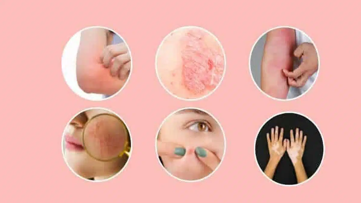 Kerala Avial Disease: Causes, Symptoms