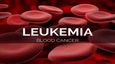 Complete Information About Leukemia