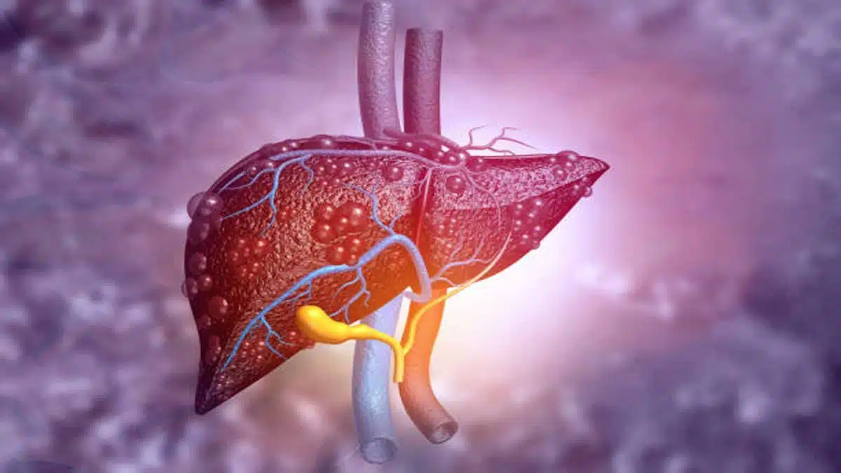 Liver Disease: Causes, Symptoms