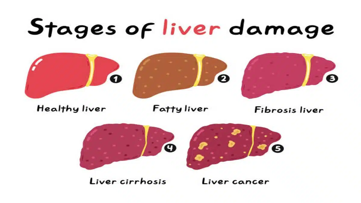 Liver Disease: Causes, Symptoms