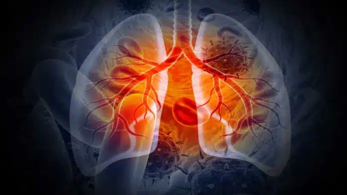 Lung Diseases: Symptoms, Causes, Types