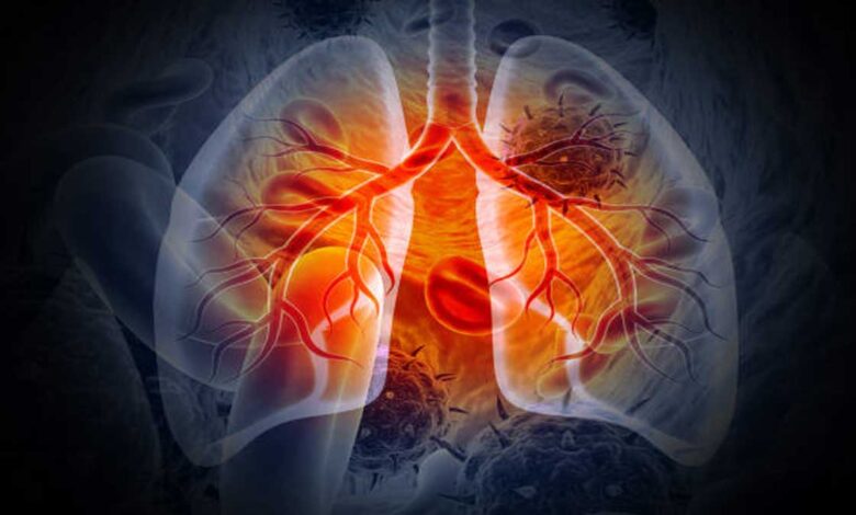 Lung Diseases: Symptoms, Causes, Types