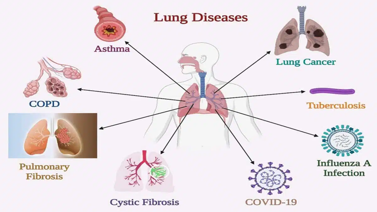 Lung Diseases: Symptoms, Causes, Types