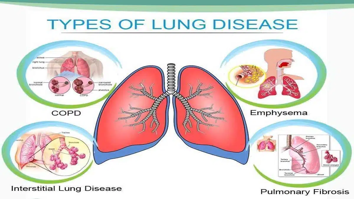 Lung Diseases: Symptoms, Causes, Types