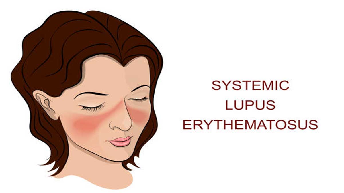 Lupus Disease: Causes, Symptoms, Treatment