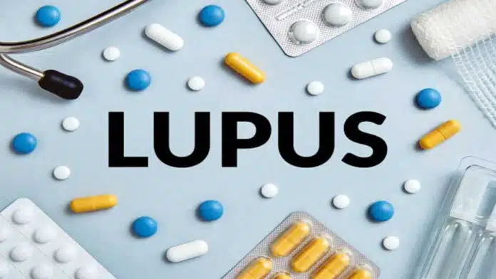 Lupus Disease: Causes, Symptoms, Treatment