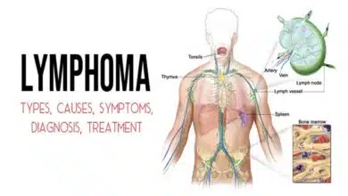 Lymphoma Disease: Causes, Symptoms