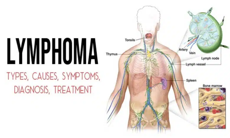 Lymphoma Disease: Causes, Symptoms